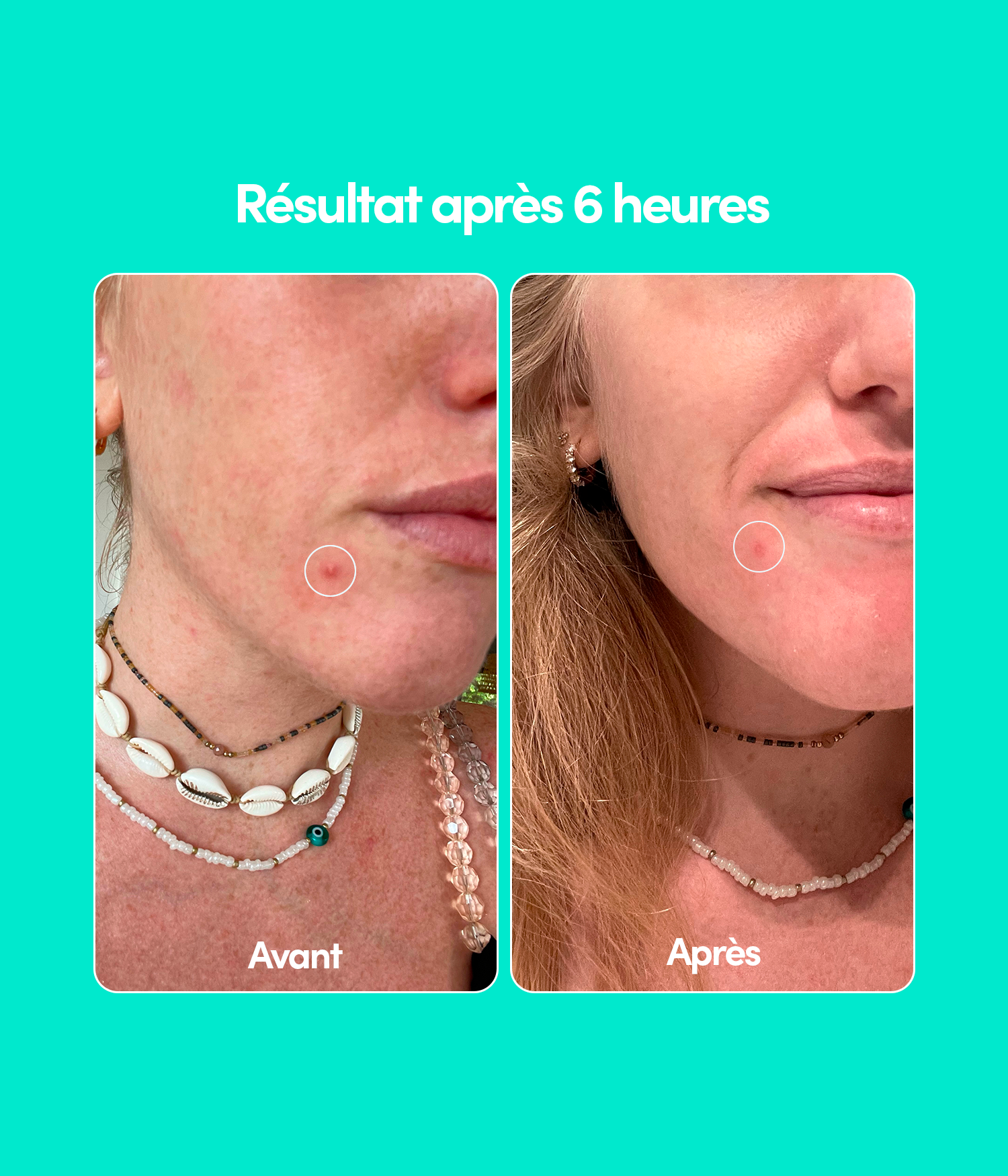 Blemish Patches pack